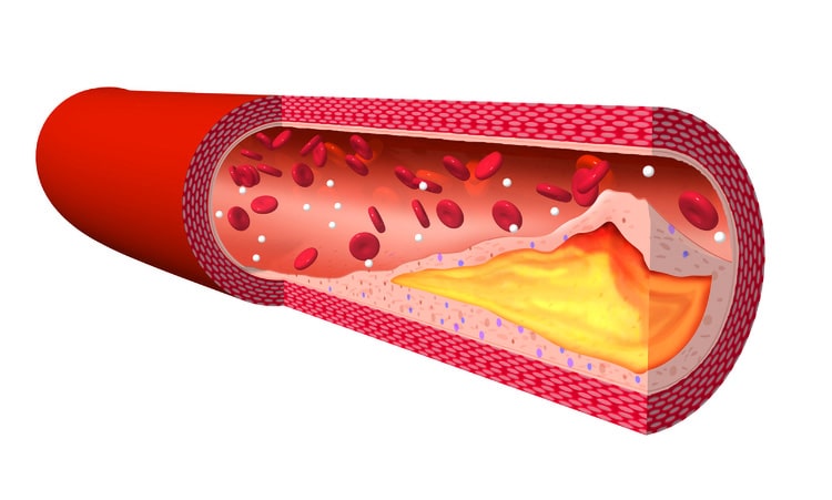 動脈硬化のイメージイラスト